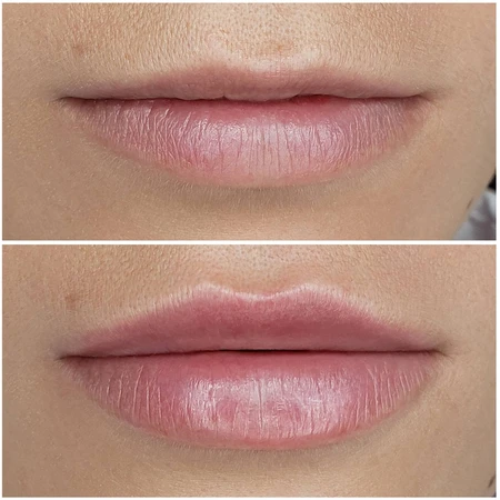 HA Dermal Fillers Lip augmentation with dermal filler to add volume, shape, and symmetry photo