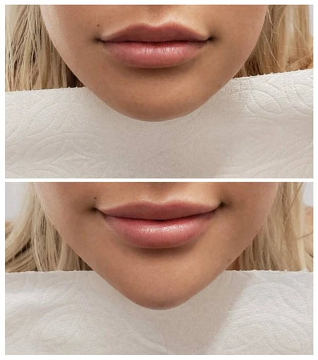 HA Dermal Fillers Chin contouring with dermal filler to add structure and definition. photo