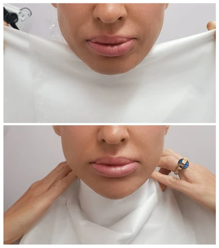 HA Dermal Fillers Chin contouring with dermal filler to add structure and definition. photo