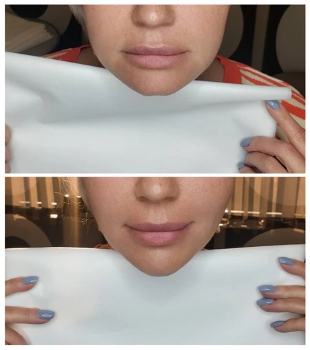 HA Dermal Fillers Chin contouring with dermal filler to add structure and definition. photo
