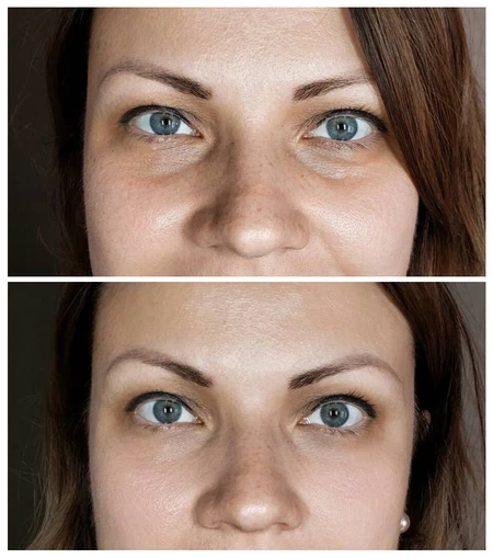 HA Dermal Fillers Filler treatment to smooth hollowing and volume loss under the eyes. photo
