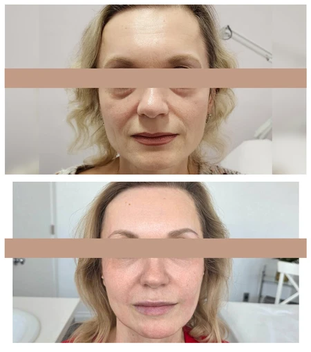 HA Dermal Fillers  photo