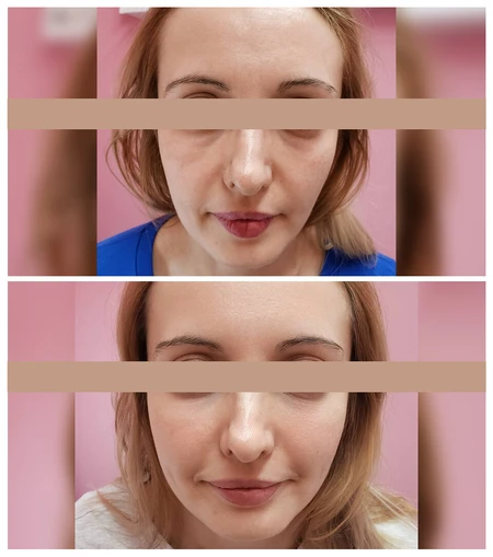 HA Dermal Fillers  photo