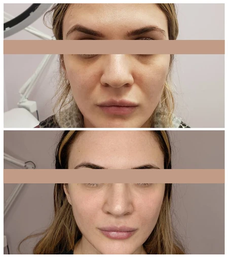 HA Dermal Fillers  photo