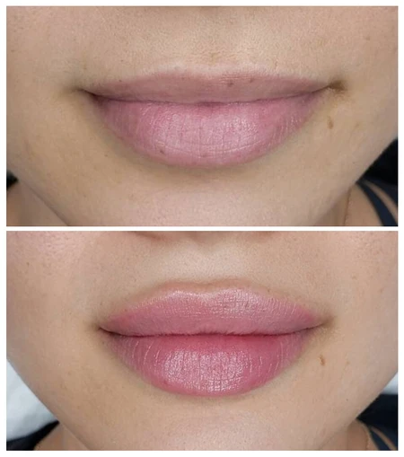 HA Dermal Fillers Lip augmentation with dermal filler to add volume, shape, and symmetry photo