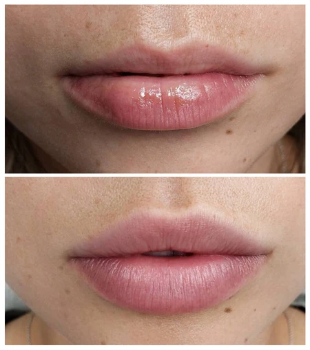 HA Dermal Fillers Lip augmentation with dermal filler to add volume, shape, and symmetry photo