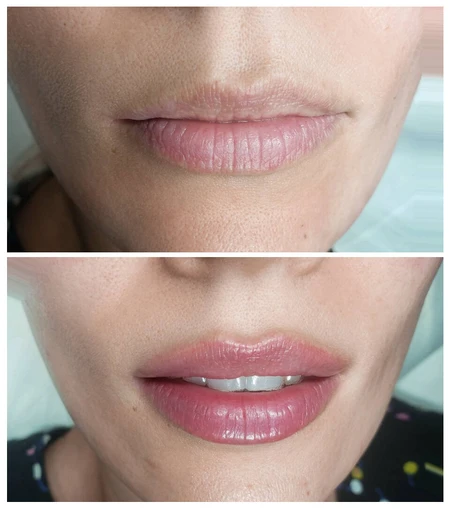 HA Dermal Fillers Lip augmentation with dermal filler to add volume, shape, and symmetry photo