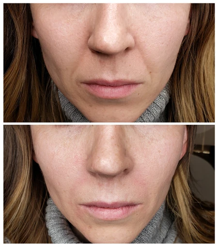 HA Dermal Fillers  photo