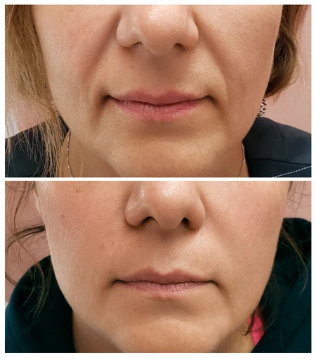 HA Dermal Fillers  photo