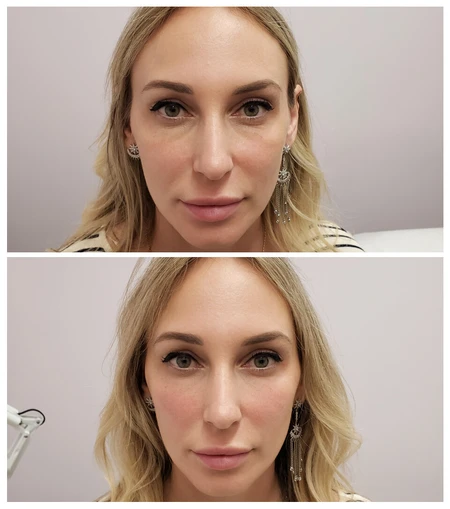 HA Dermal Fillers Filler treatment to smooth hollowing and volume loss under the eyes. photo